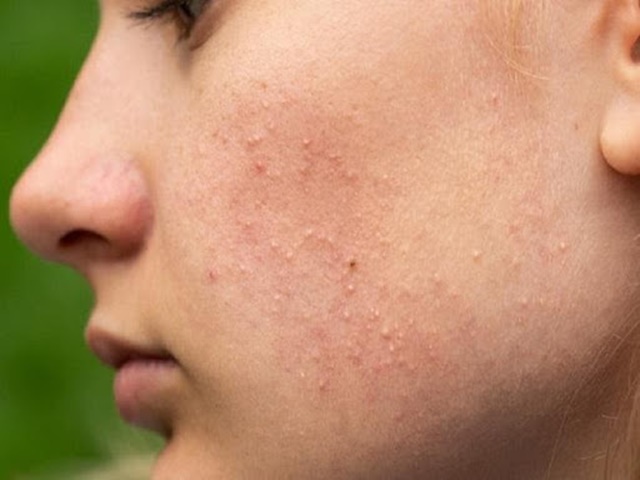 Peel da bị nổi mụn nước liệu có nguy hiểm? Da nổi mụn nước sau khi peel khiến nhiều người lo lắng
