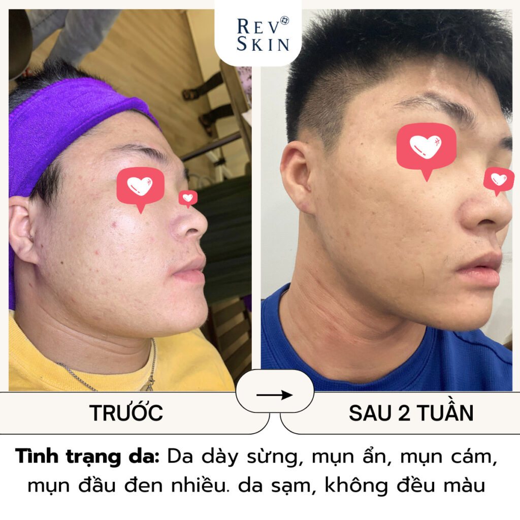 Chuyển giao công nghệ Revskin