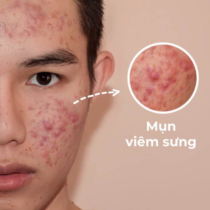 Chuyển giao công nghệ Revskin