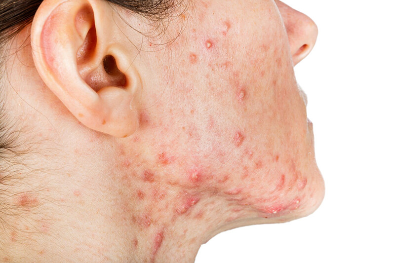 Chuyển giao công nghệ Revskin