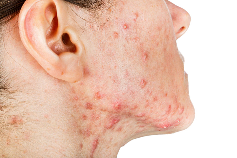 Chuyển giao công nghệ Revskin