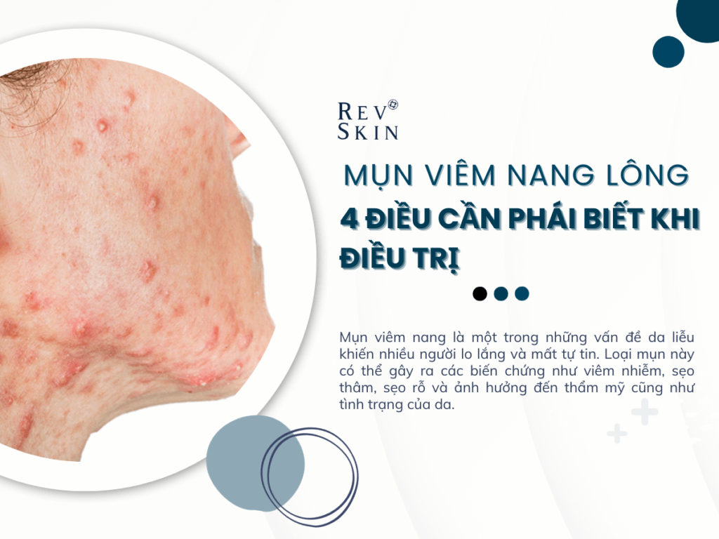 Chuyển giao công nghệ Revskin