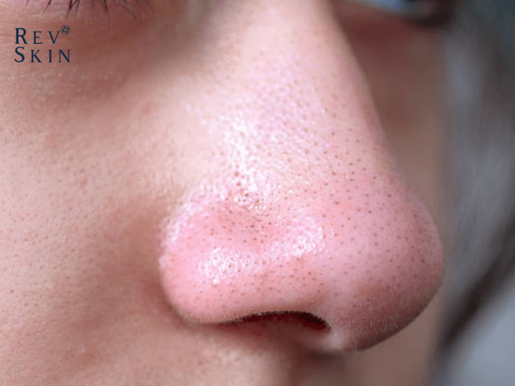 Chuyển giao công nghệ Revskin