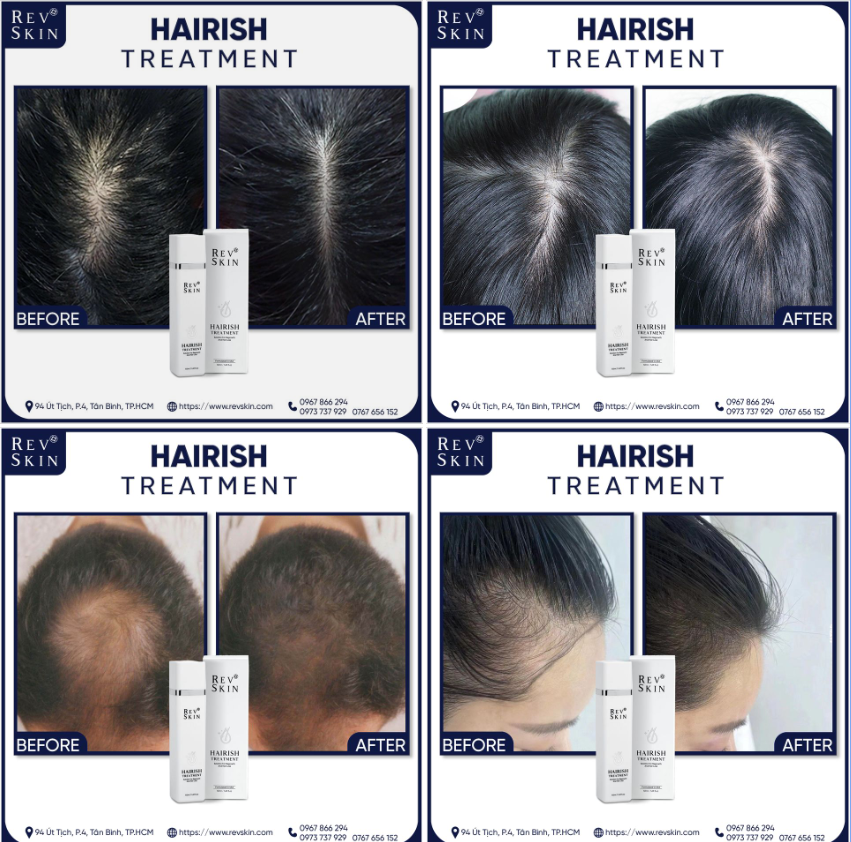 Chuyển giao công nghệ Revskin