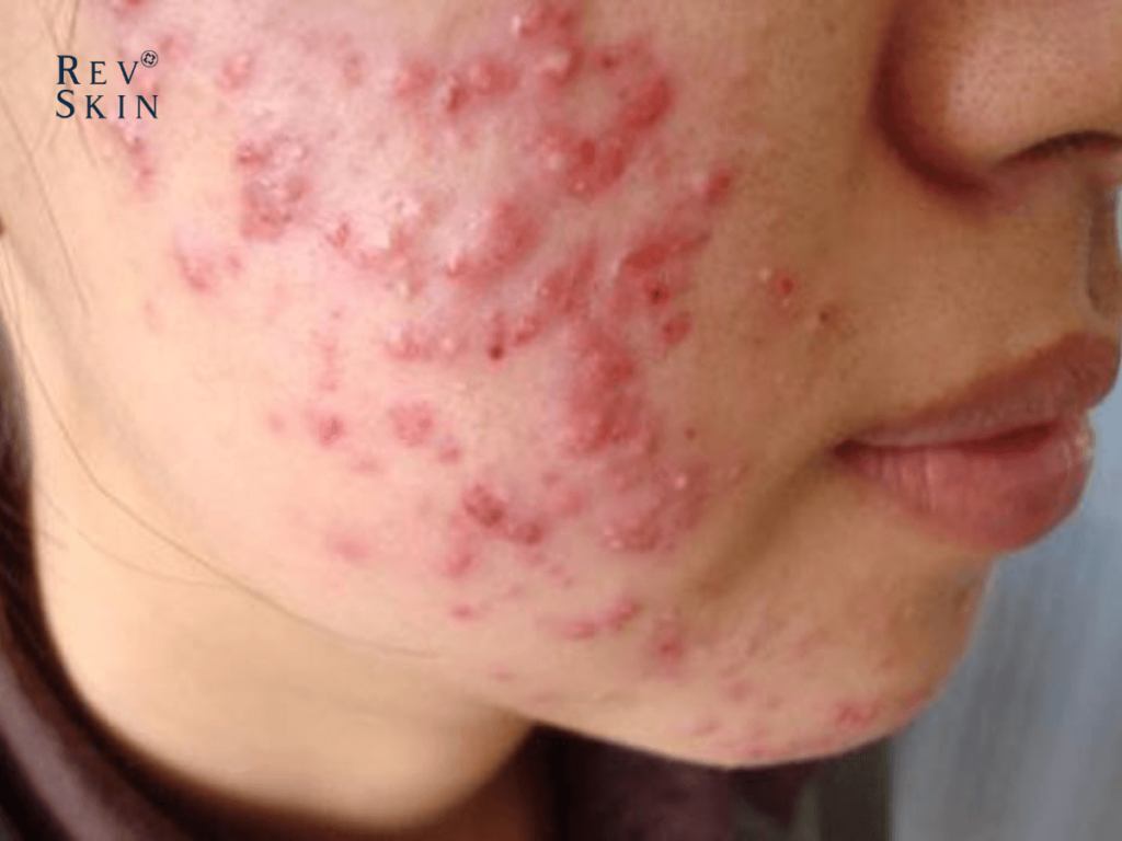 Chuyển giao công nghệ Revskin