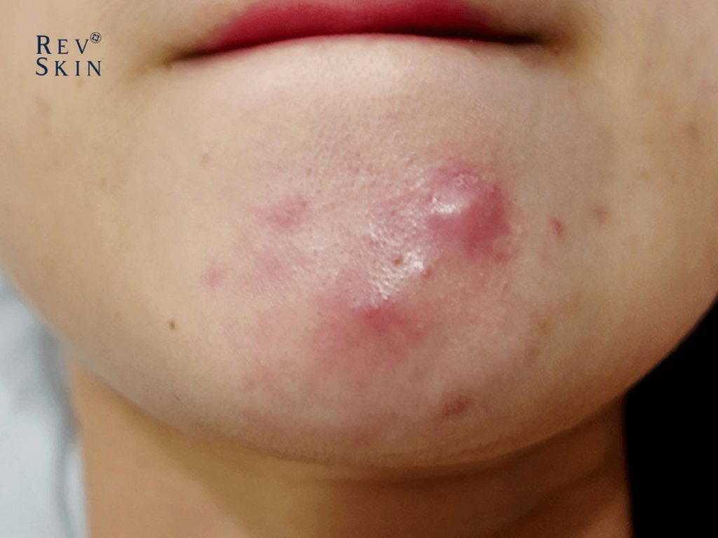 Chuyển giao công nghệ Revskin