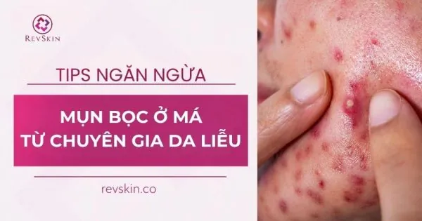 tips ngăn ngừa mụn bọc ở má từ chuyên gia da liễu