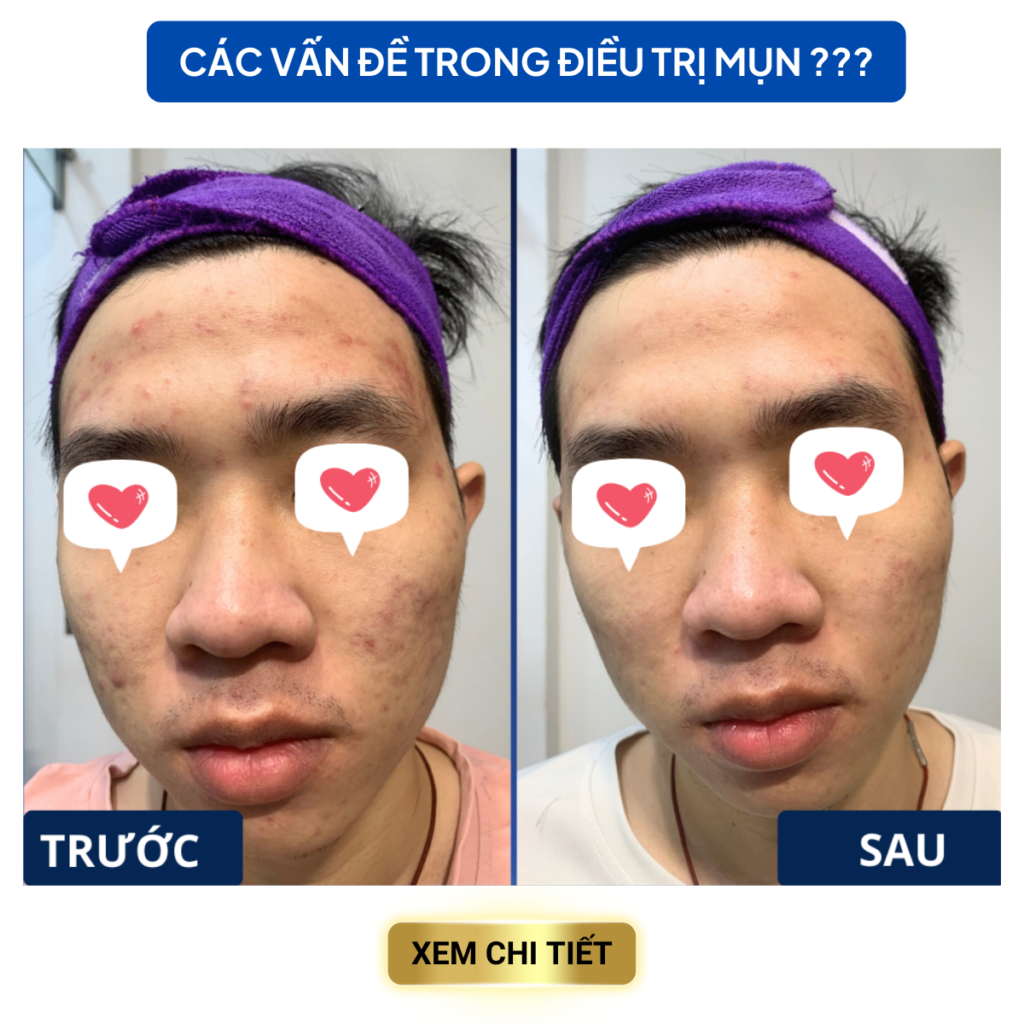 Chuyển giao công nghệ Revskin