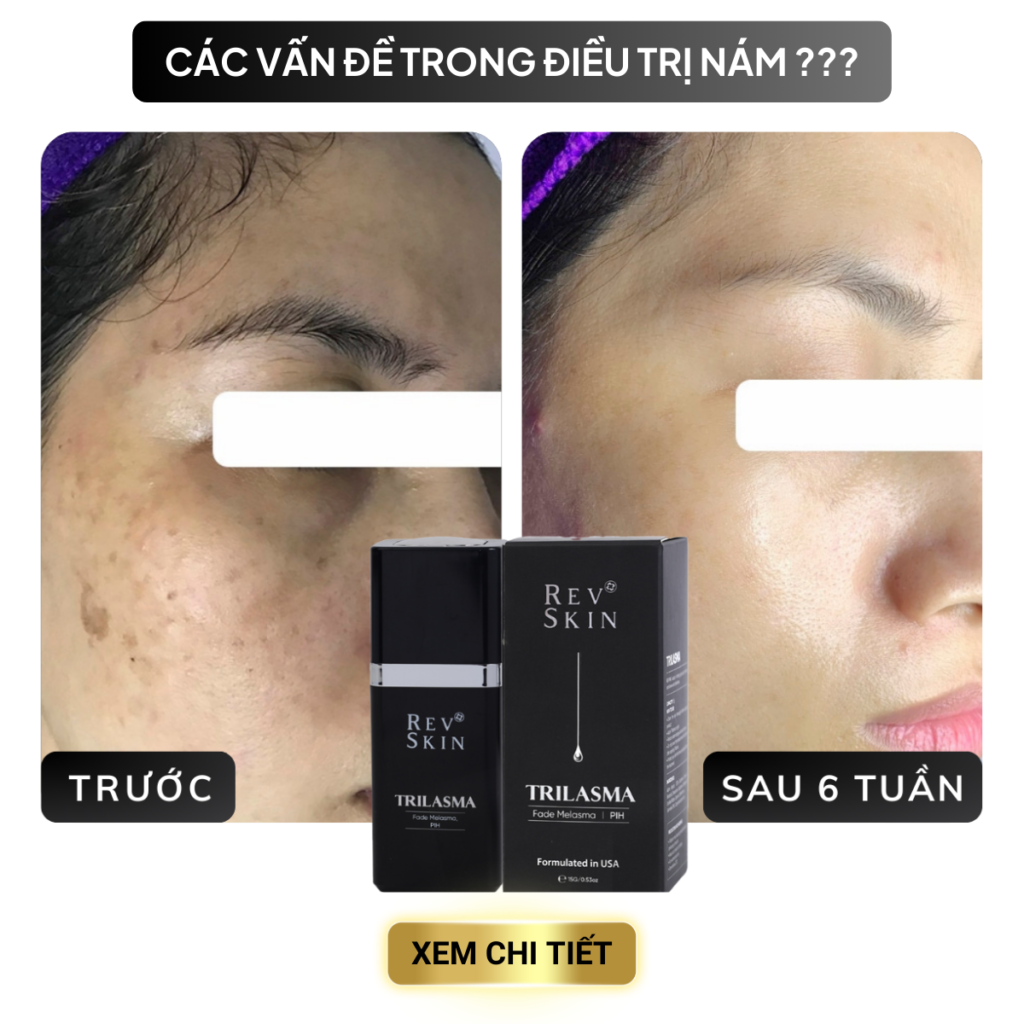 Chuyển giao công nghệ Revskin