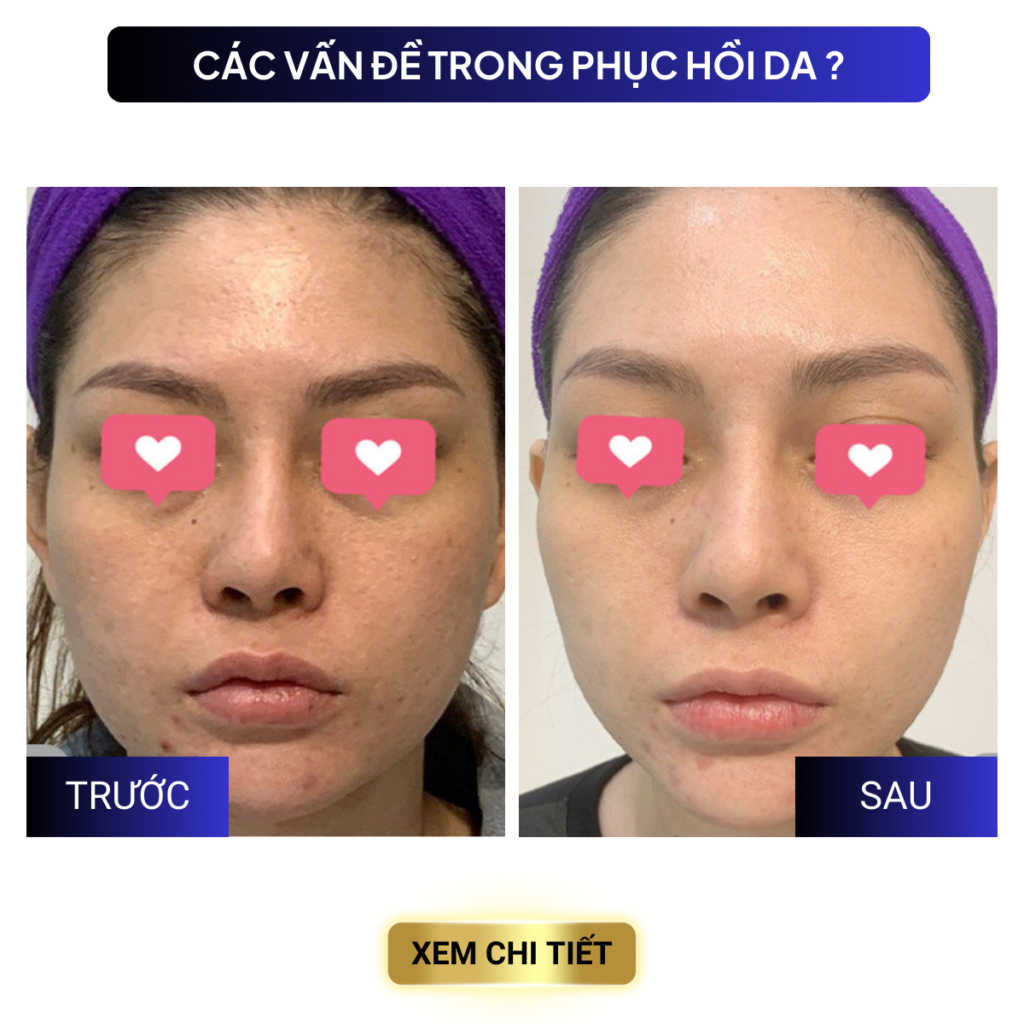 Chuyển giao công nghệ Revskin