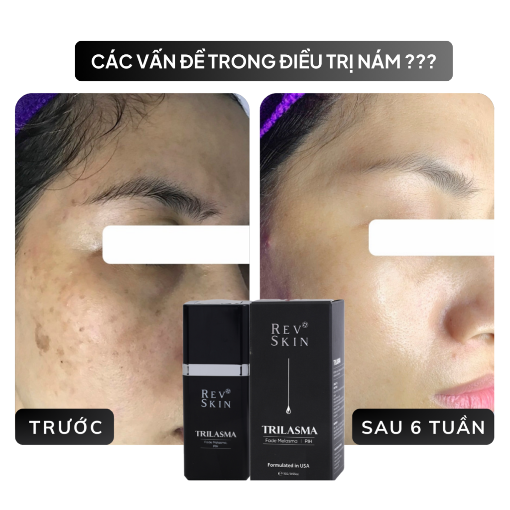 Chuyển giao công nghệ Revskin