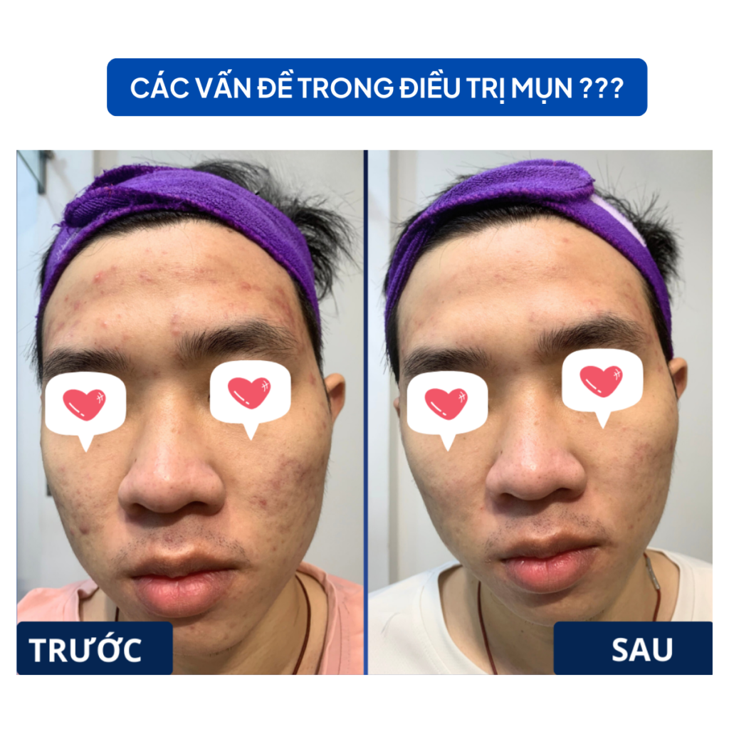 Chuyển giao công nghệ Revskin