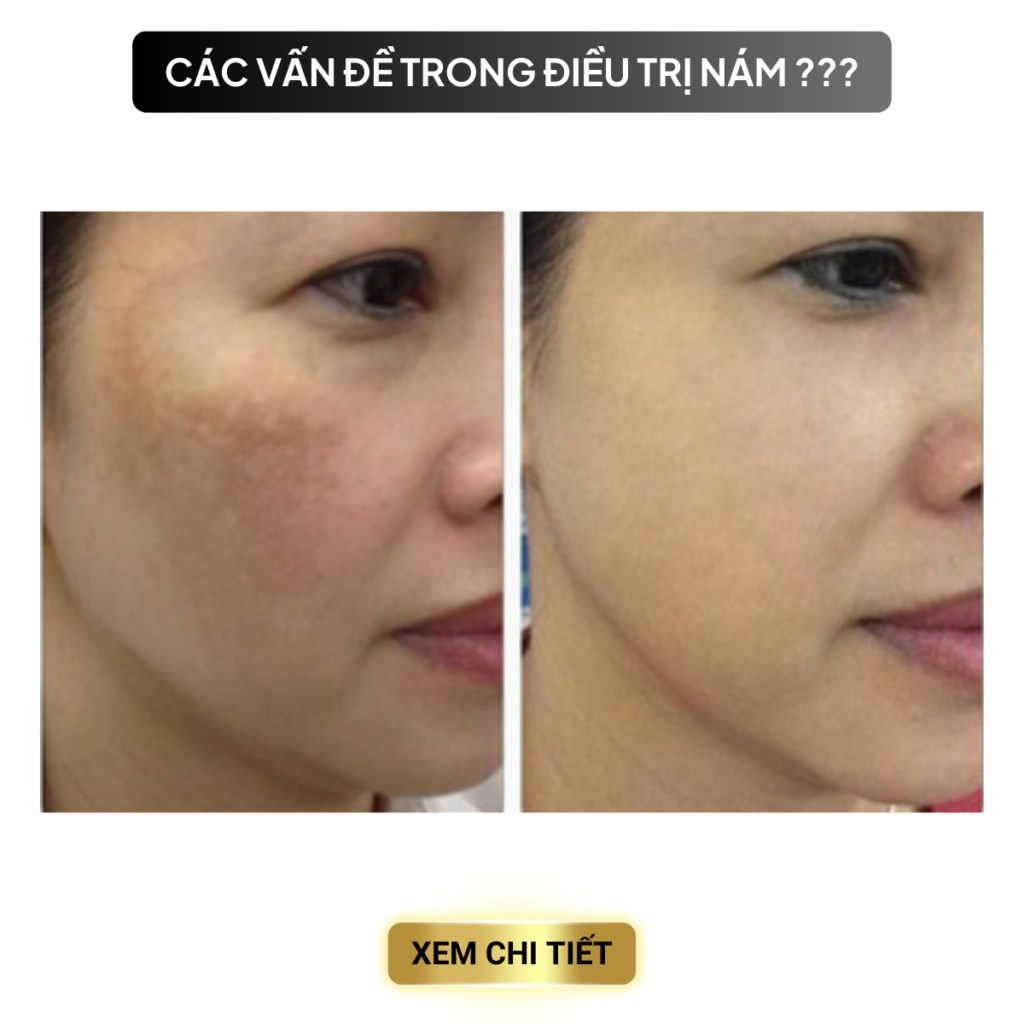Chuyển giao công nghệ Revskin