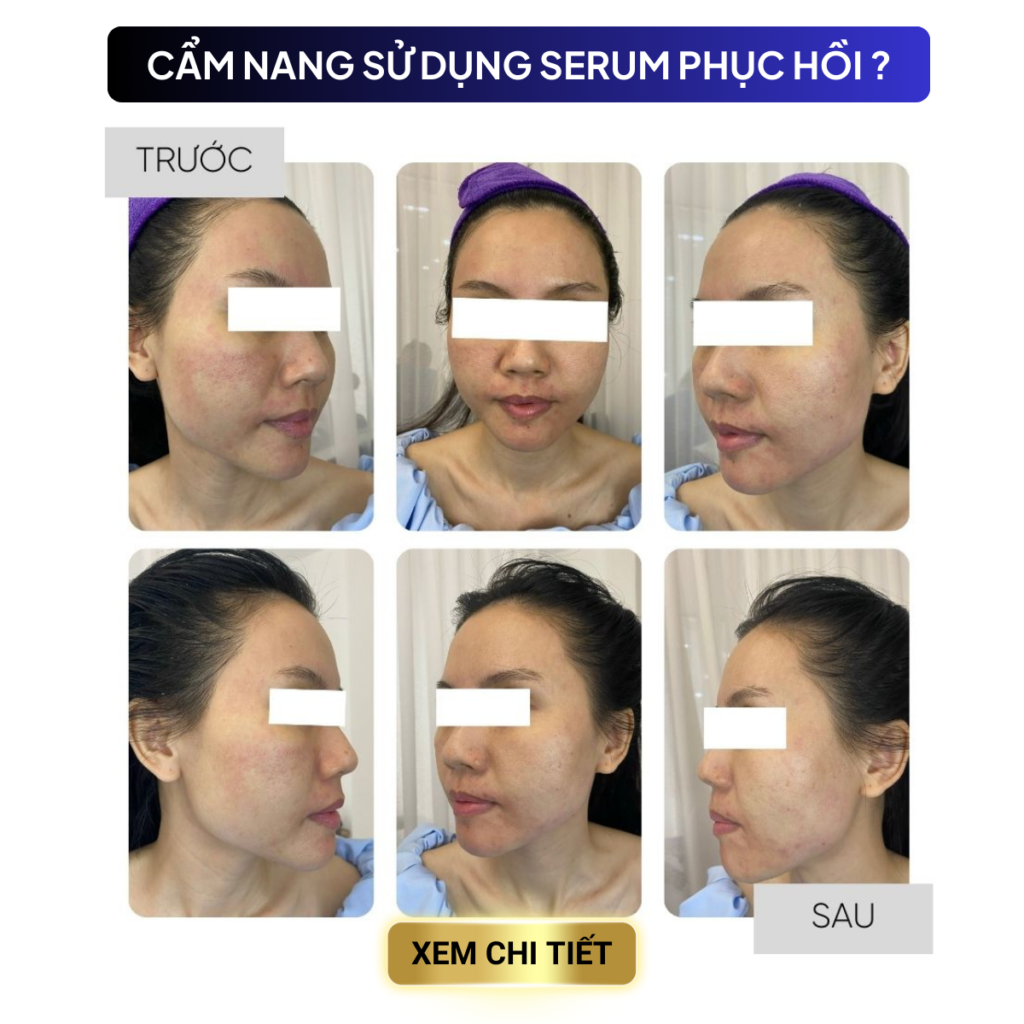 Chuyển giao công nghệ Revskin