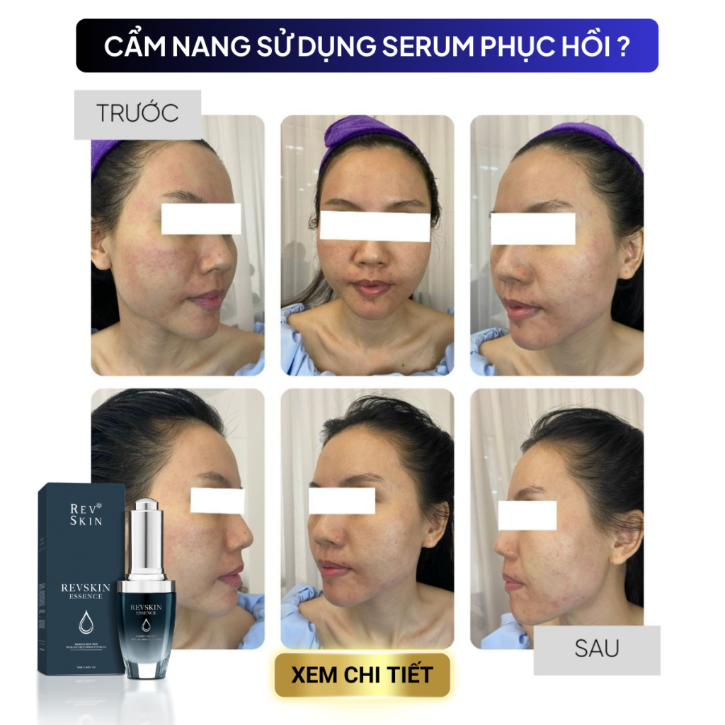 Chuyển giao công nghệ Revskin