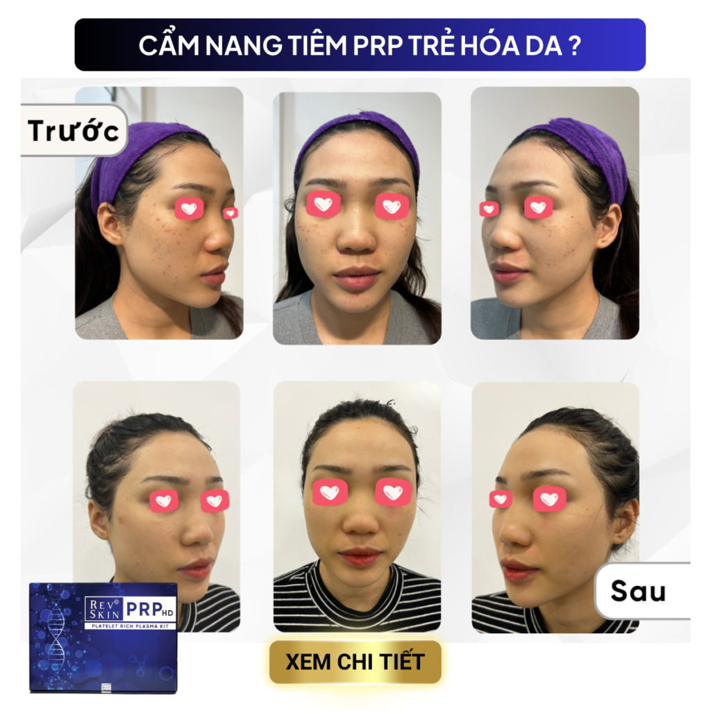 Chuyển giao công nghệ Revskin