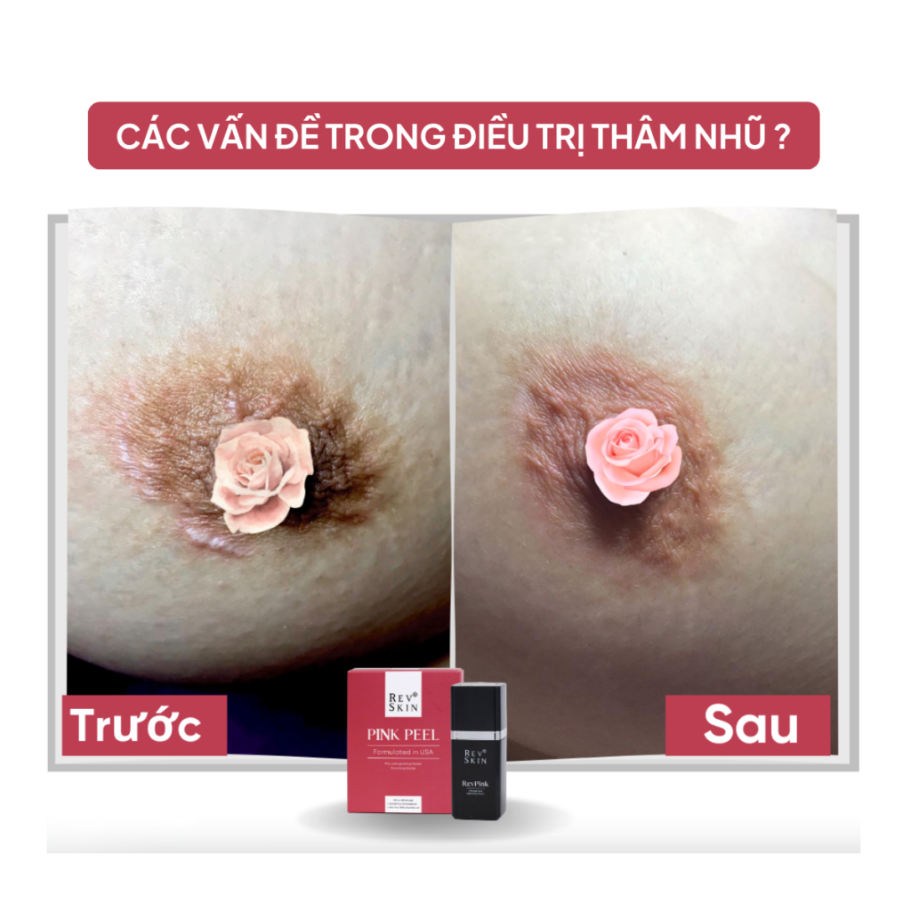 Chuyển giao công nghệ Revskin