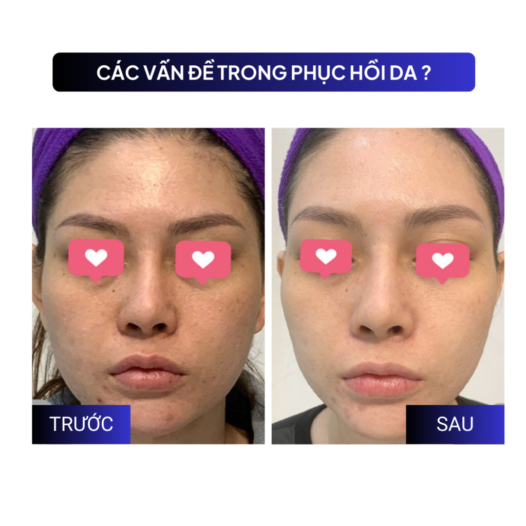 Chuyển giao công nghệ Revskin
