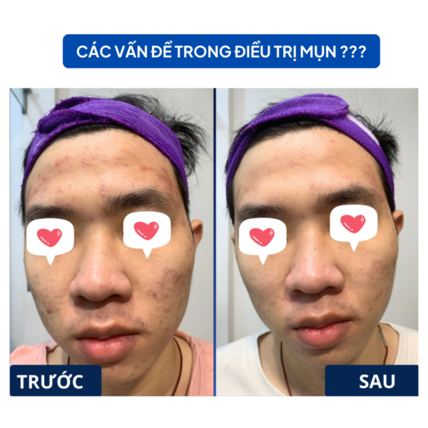 PHÁC ĐỒ ĐIỀU TRỊ MỤN HIỆU QUẢ SAU 7 NGÀY cac van de trong dieu tri mun