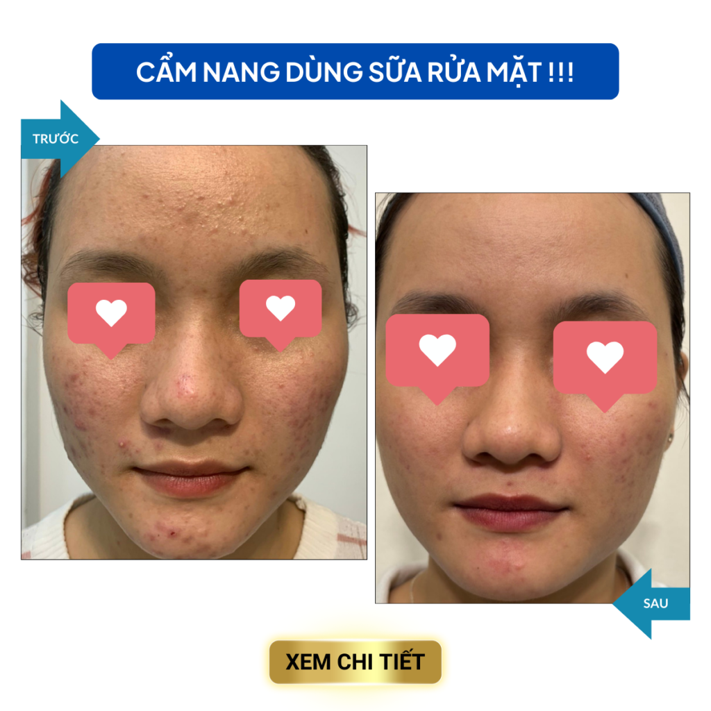 PHÁC ĐỒ ĐIỀU TRỊ MỤN HIỆU QUẢ SAU 7 NGÀY cac van de trong dieu tri mun 7 1