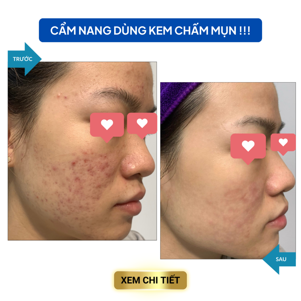 PHÁC ĐỒ ĐIỀU TRỊ MỤN HIỆU QUẢ SAU 7 NGÀY cac van de trong dieu tri mun 8