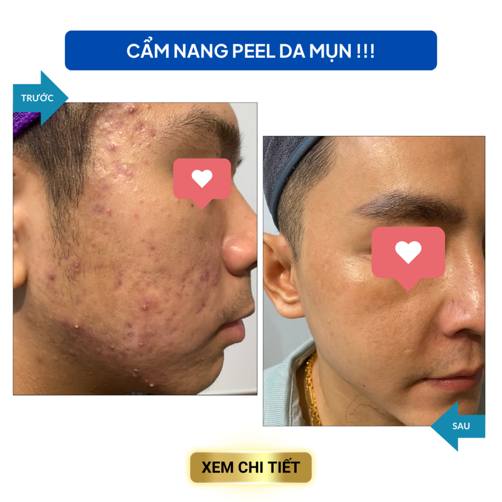 PHÁC ĐỒ ĐIỀU TRỊ MỤN HIỆU QUẢ SAU 7 NGÀY cac van de trong dieu tri mun 9