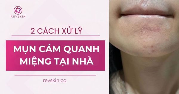 2 cách xử lý mụn cám quanh miệng tại nhà