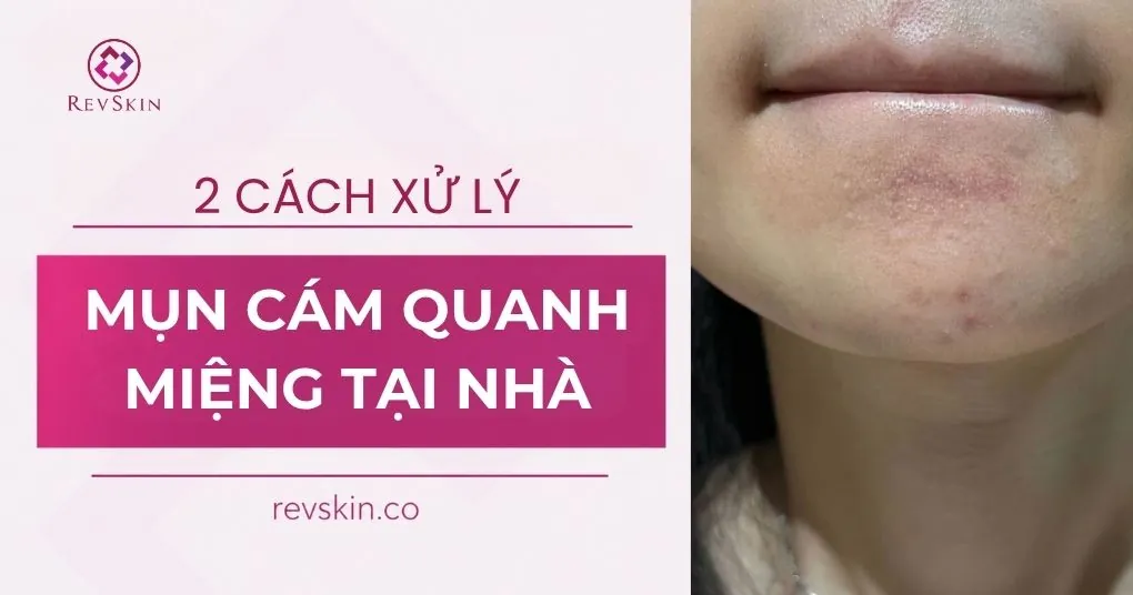 2 cách xử lý mụn cám quanh miệng tại nhà 2 cách xử lý mụn cám quanh miệng tại nhà