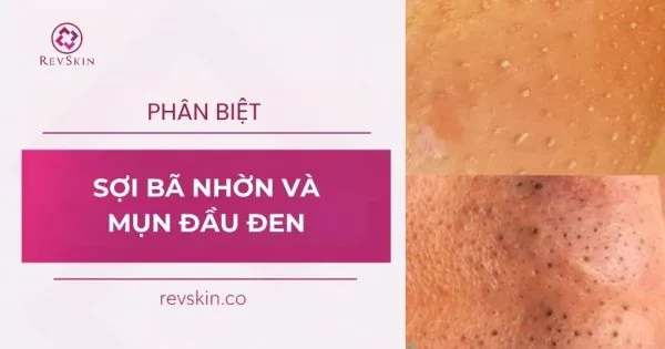 phân biệt sợi bã nhờn và mụn đầu đen