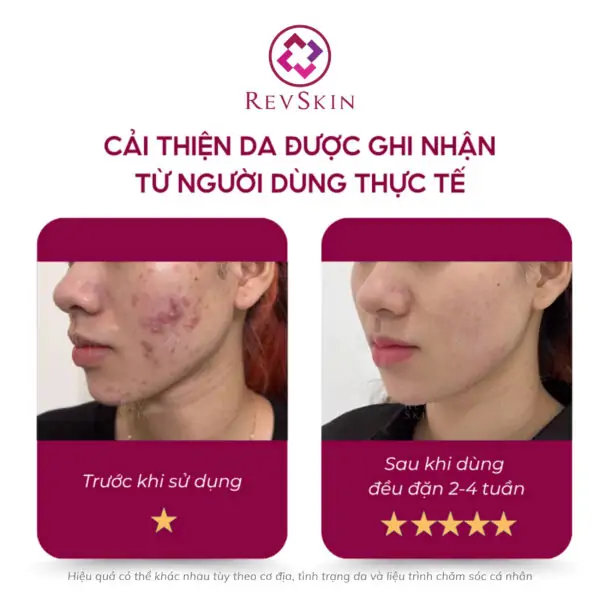 revskin blemish clear cream fb1 1