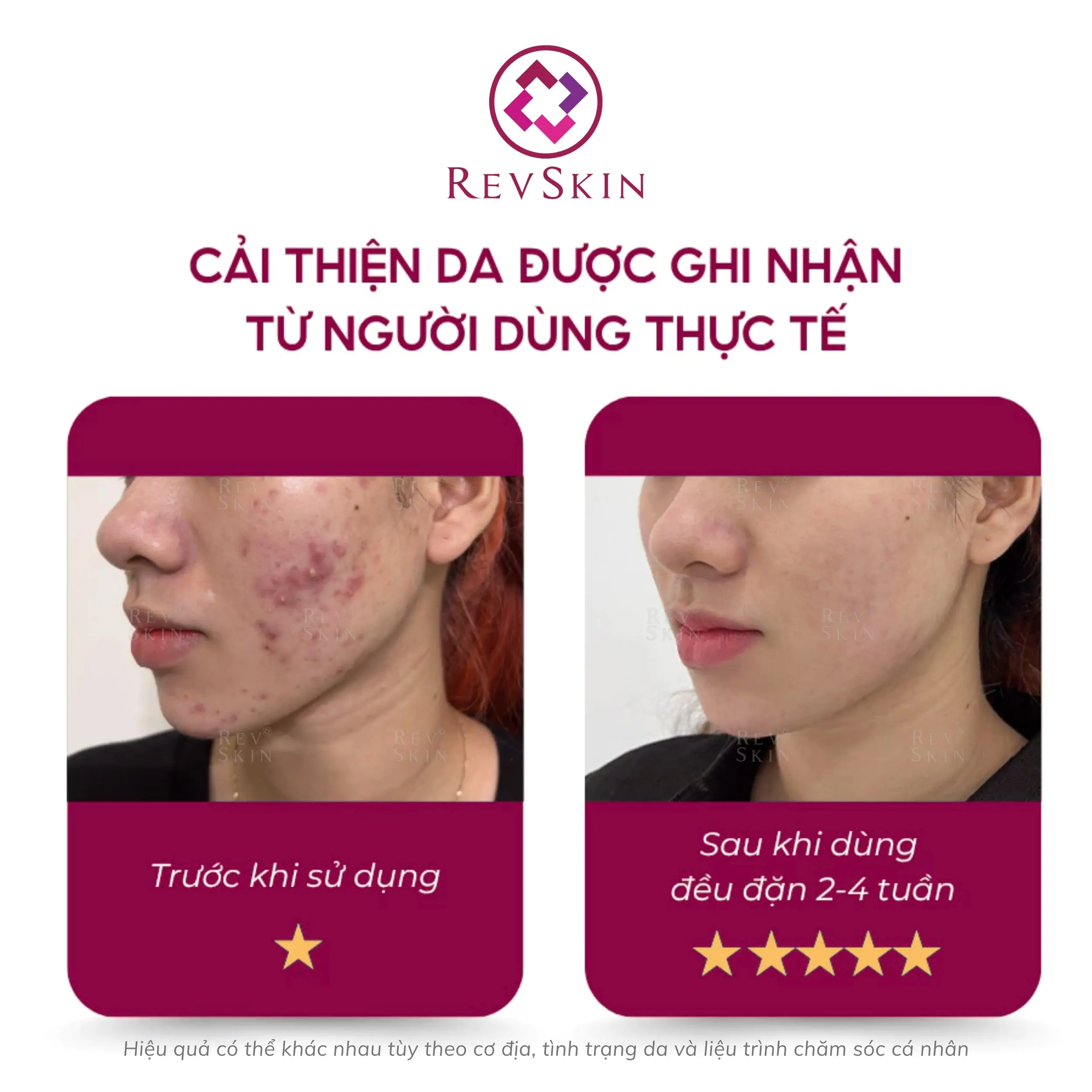 Sữa rửa mặt Revskin Activecare Cleanser cho da dầu, mụn và giảm mụn đầu đen revskin blemish clear cream fb1 1
