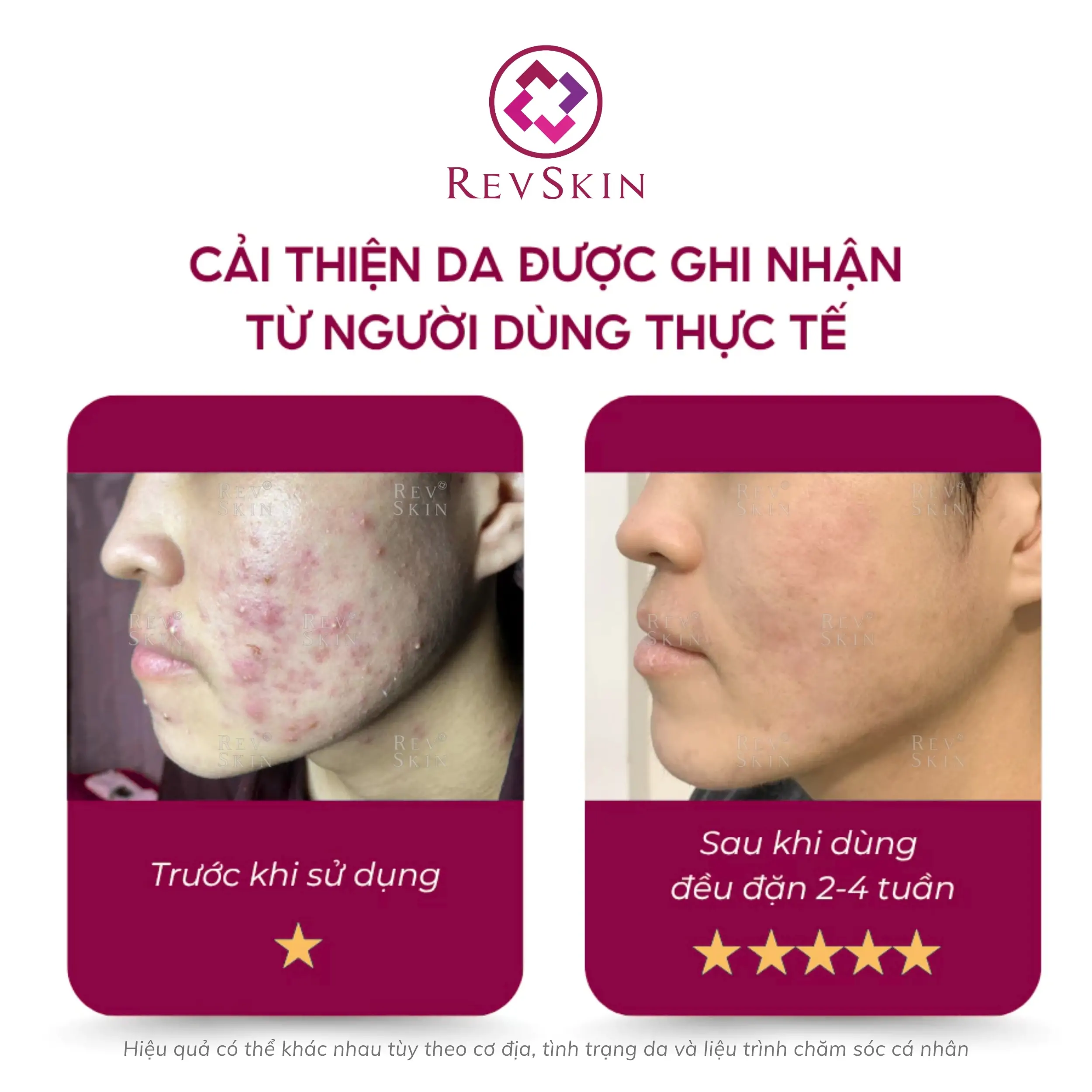 Sữa rửa mặt Revskin Activecare Cleanser cho da dầu, mụn và giảm mụn đầu đen revskin blemish clear cream fb2 1
