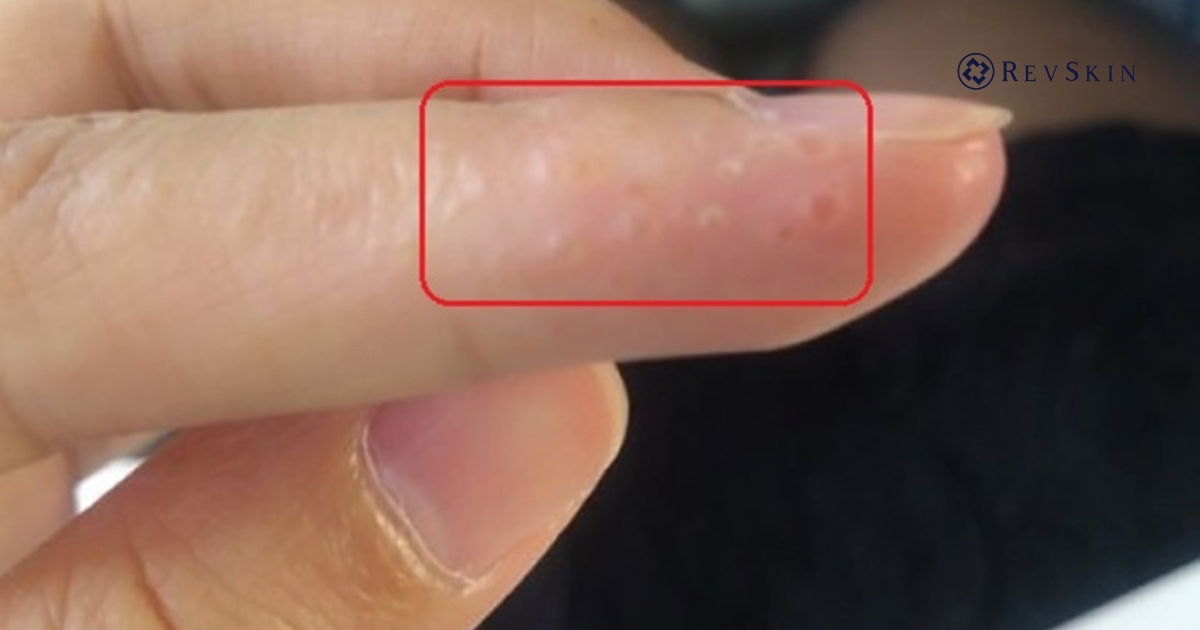 Bị nổi mụn nước là gì? Nguyên nhân, dấu hiệu và cách xử lý an toàn Bị mụn nước là gì