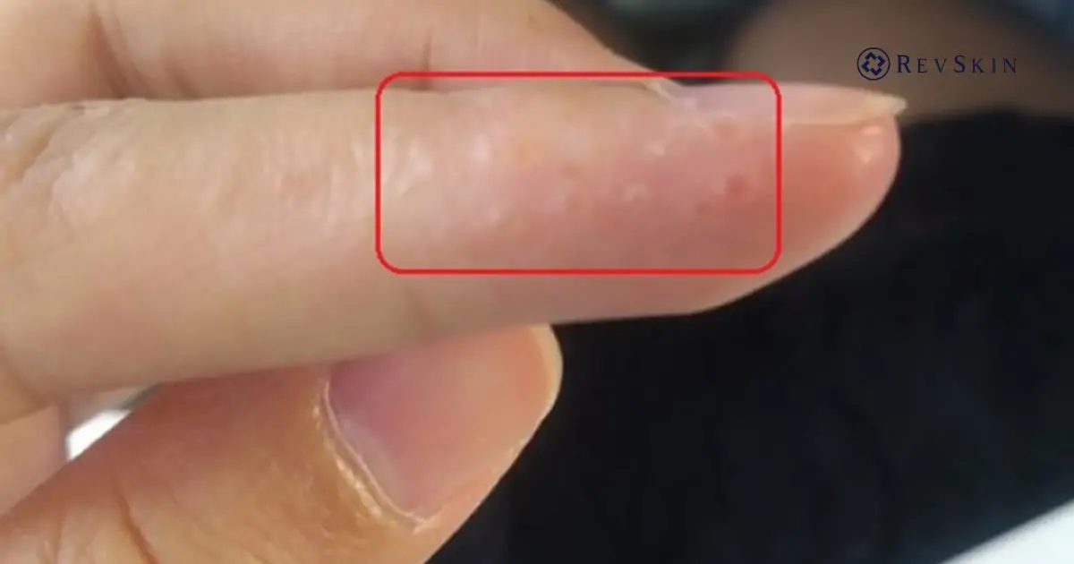 Bị nổi mụn nước là gì? Nguyên nhân, dấu hiệu và cách xử lý an toàn Bị mụn nước là gì