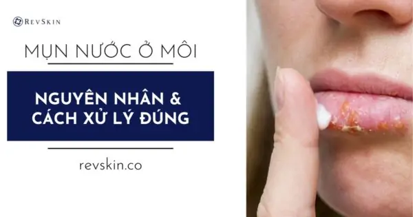 Bị mụn nước ở môi là bệnh gì