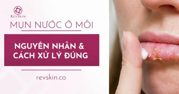 bị mụn nước ở môi là bệnh gì