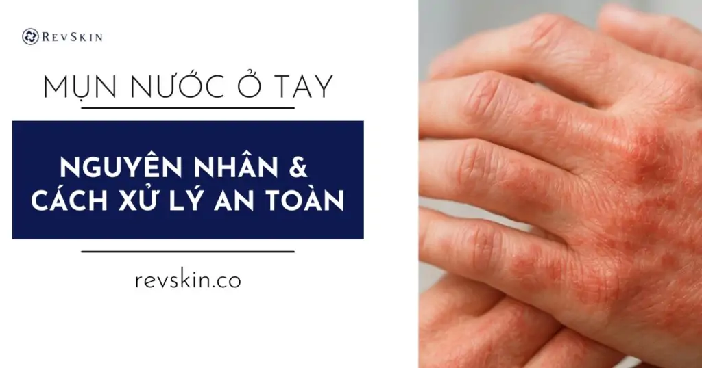 Bị mụn nước ở tay là gì? Nguyên nhân, dấu hiệu và cách xử lý an toàn cho da Bị mụn nước ở tay là bệnh gì