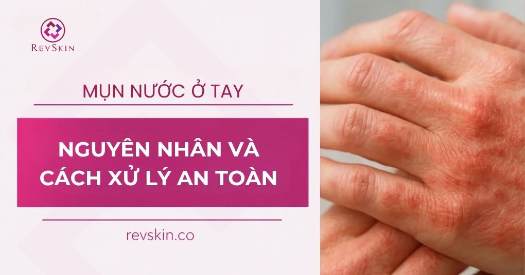 Bị mụn nước ở tay là gì? Nguyên nhân, dấu hiệu và cách xử lý an toàn cho da bị mụn nước ở tay là bệnh gì
