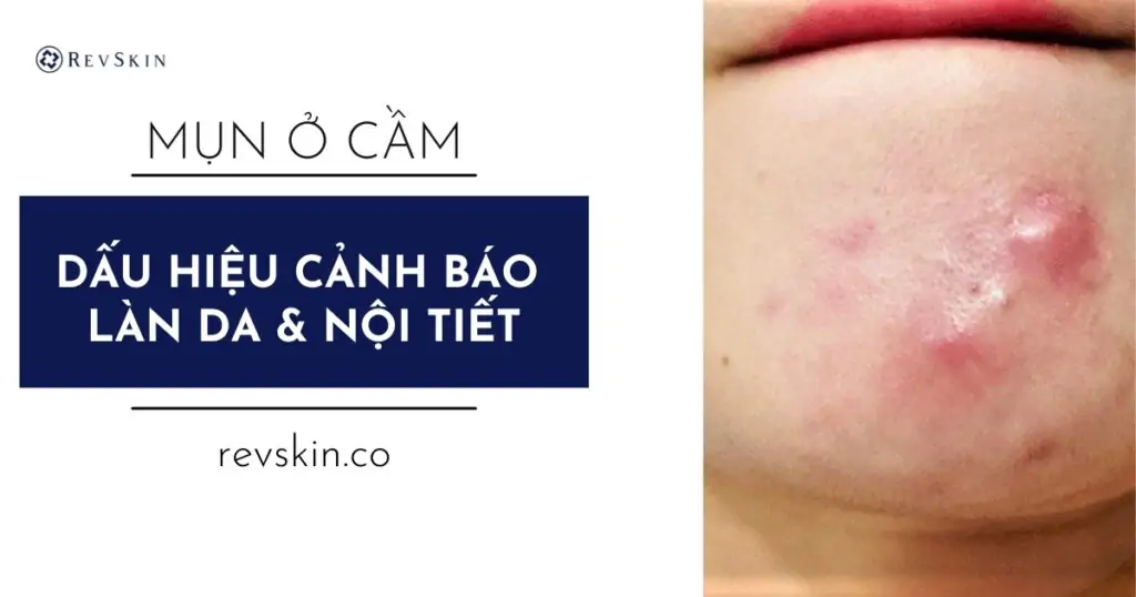 Bị mụn ở cằm là gì? Dấu hiệu cảnh báo làn da & nội tiết bạn không nên bỏ qua Bị mụn ở cầm
