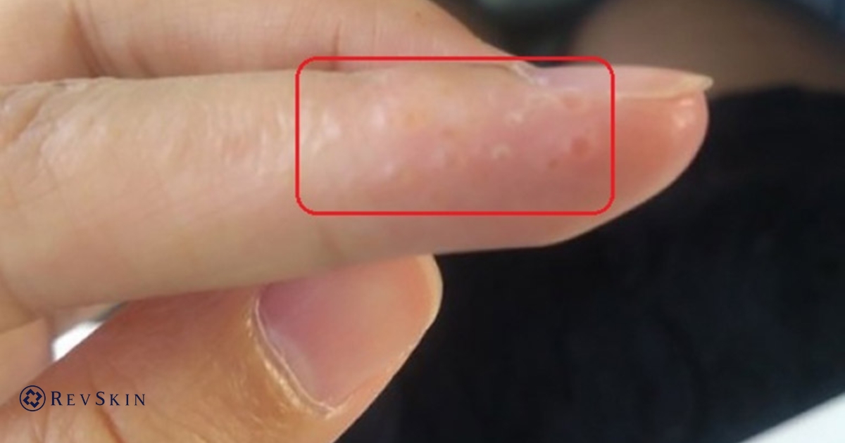 Bị mụn nước ở tay là gì? Nguyên nhân, dấu hiệu và cách xử lý an toàn cho da Các laoij mụn ở tay