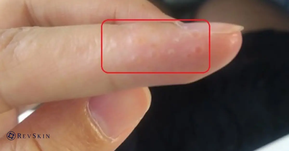 Bị mụn nước ở tay là gì? Nguyên nhân, dấu hiệu và cách xử lý an toàn cho da Các laoij mụn ở tay