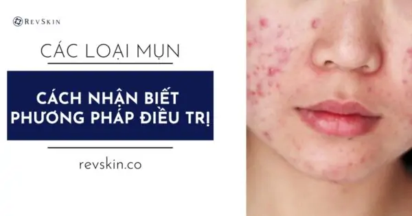 Các loại mụn thường gặp