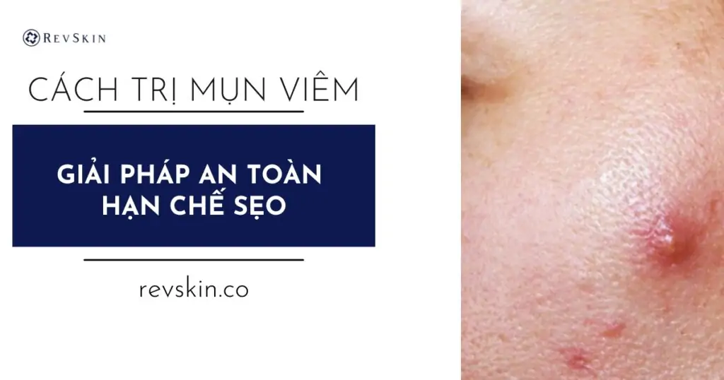 Trị mụn viêm đúng cách: Giải pháp an toàn, hạn chế sẹo Cách điều trị mụn viêm đúng cách