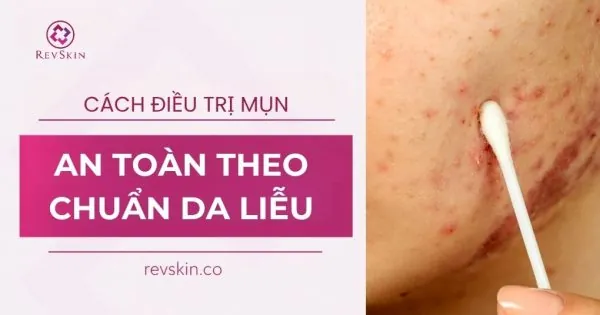 cách điều trị mụn an toàn