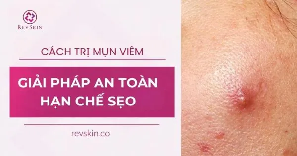 cách trị mụn viêm an toàn hạn chế sẹo