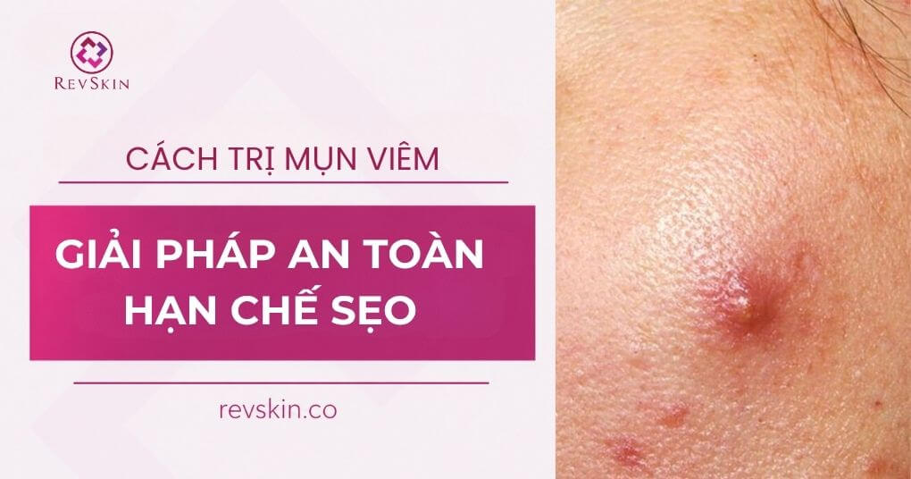 Trị mụn viêm đúng cách: Giải pháp an toàn, hạn chế sẹo cách trị mụn viêm an toàn hạn chế sẹo