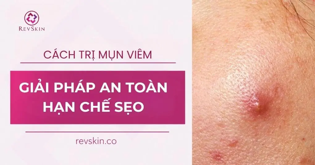 cách trị mụn viêm an toàn hạn chế sẹo