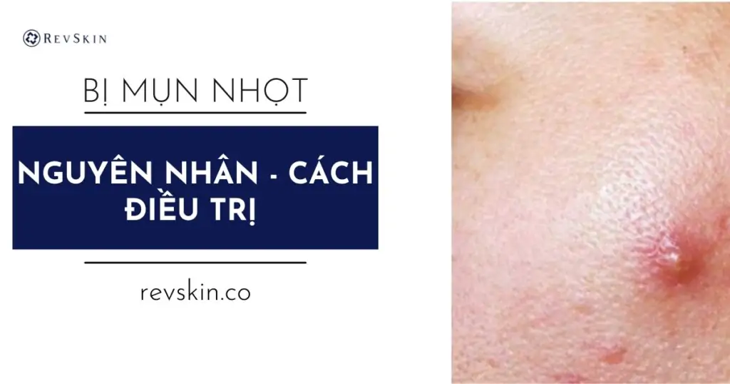 Bị Mụn Nhọt: 7 Sự Thật Quan Trọng Và Cách Điều Trị Hiệu Quả Nhất Hiện Nay Điều trị bị mụn nhọt ở da