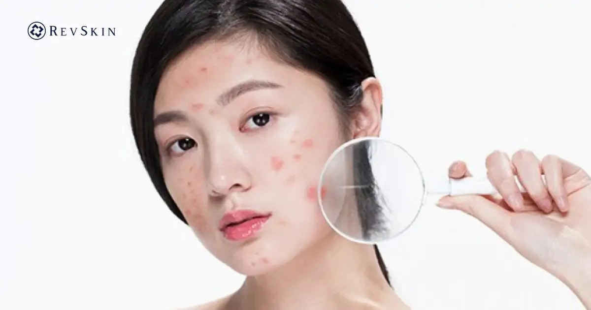 Cách điều trị mụn hiệu quả, an toàn theo chuẩn da liễu Điều trị mụn theo từng mức độ