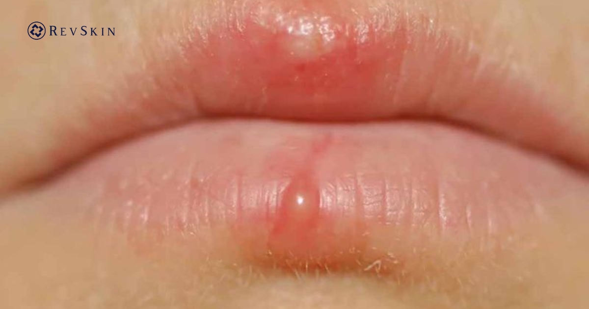 Bị mụn nước ở môi là bệnh gì? Nguyên nhân & cách xử lý đúng Kích ứng cơ học gây mụn ở môi